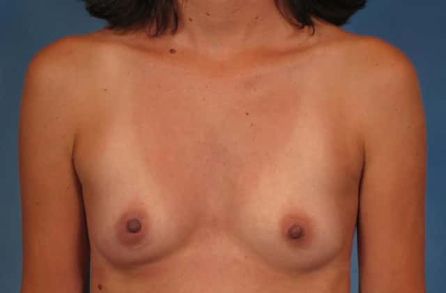 Breast Augmentation Before & After Case 249 before
