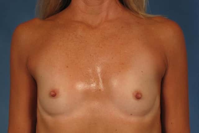 Breast Augmentation Before & After Case 258 before