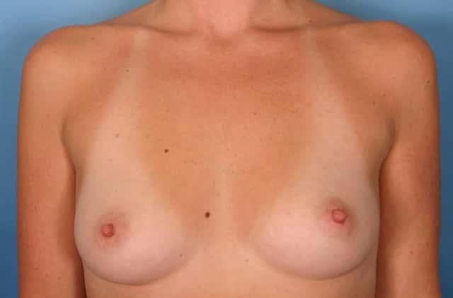 Breast Augmentation Before & After Case 29 before