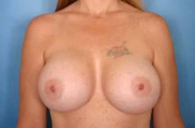 Breast Augmentation Before & After Case 3 after