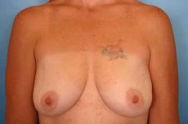 Breast Augmentation Before & After Case 3 before