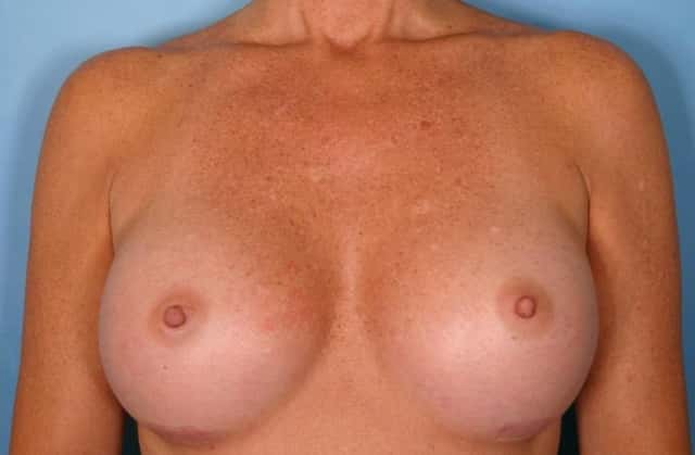 Breast Augmentation Before & After Case 36 after