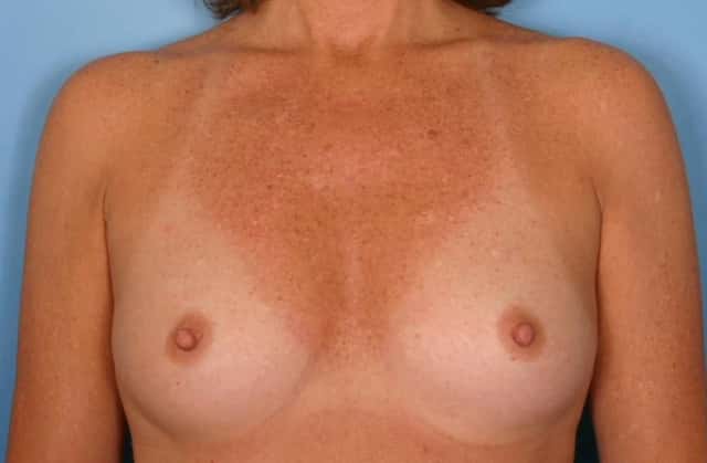 Breast Augmentation Before & After Case 36 before
