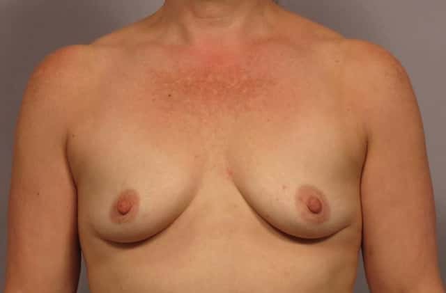 Breast Augmentation Photos from Front View