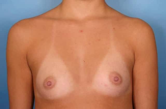 Breast Augmentation Before & After Case 39 before