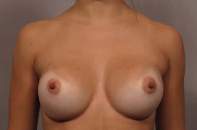 Front view of Dr. Kent Hasen Breast Augmentation with Silicone Implants, 1 Year After