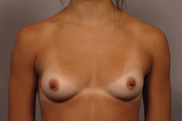 Front view of Dr. Kent Hasen Breast Augmentation with Silicone Implants, before