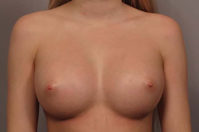 Front view of Breast Augmentation by Dr. Kent Hasen with 375 cc Silicone Implants, 1 Month After