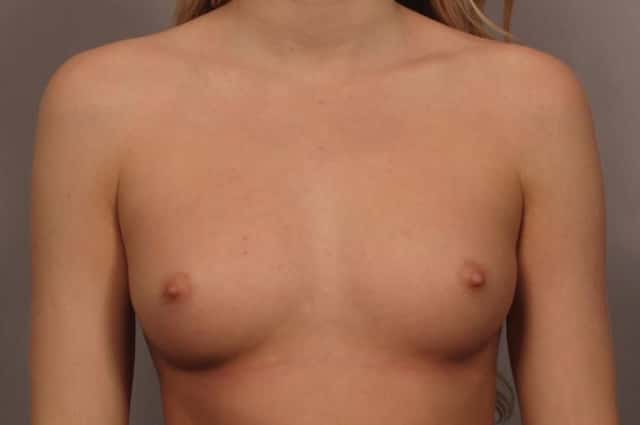 Front view of Breast Augmentation by Dr. Kent Hasen with 375 cc Silicone Implants, Before