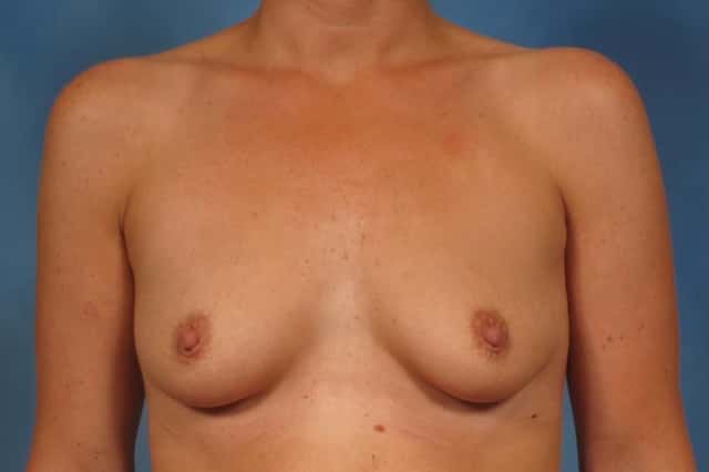 Front view of Silicone Breast Augmentation by Dr. Kent Hasen in 46 year old woman, Before
