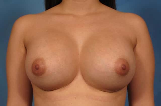 Front view of a 22-year-old woman who had breast augmentation by Dr. Kent Hasen, 1 Year After