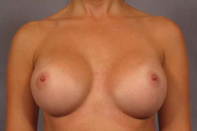 Front view of a 30-year-old breast augmentation patient of Dr. Kent Hasen, 3 Months After