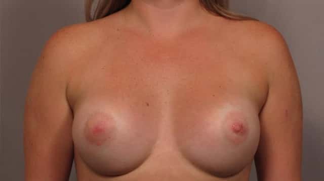 Breast Augmentation Frontal View 1 Year Post - Op