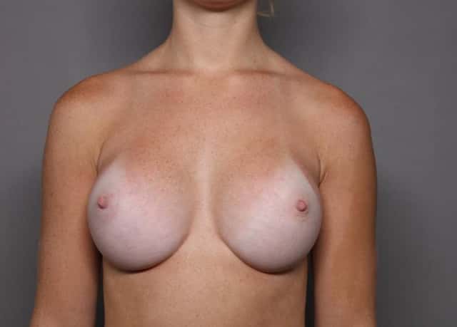 Breast Augmentation Frontal View 6 Months Post- Op