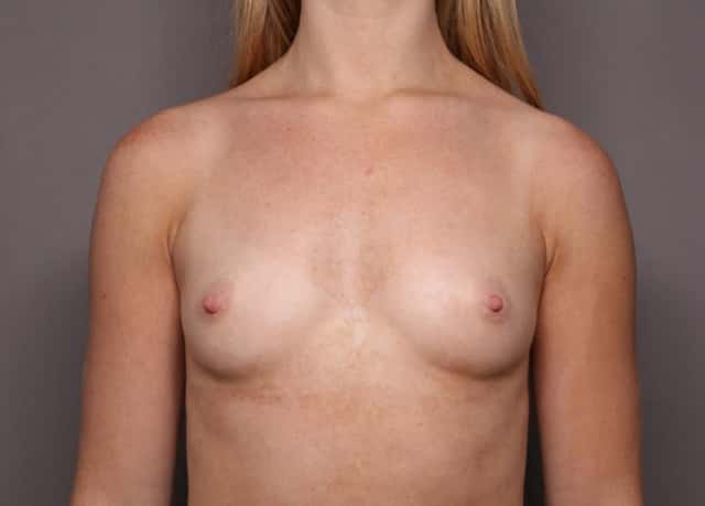 Breast Augmentation Frontal View Before