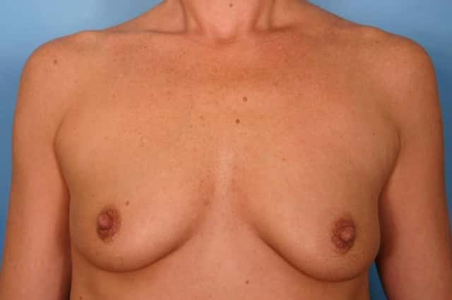 Breast Augmentation Before & After Case 47 before