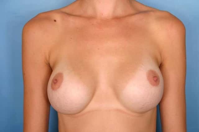 Breast Augmentation Before & After Case 60 after