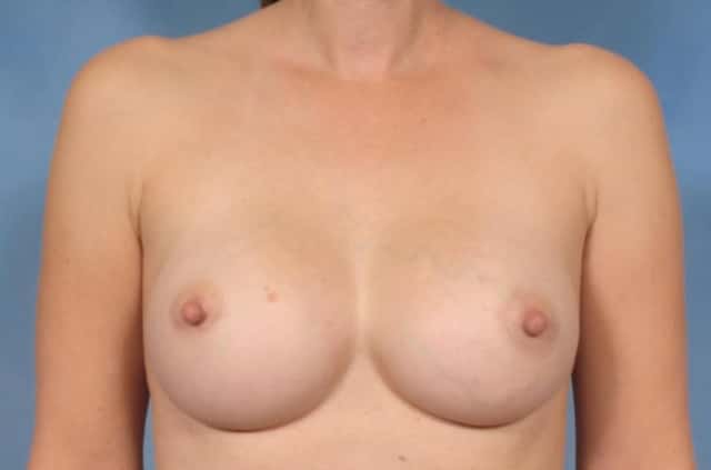 Breast Augmentation Before & After Case 76 after