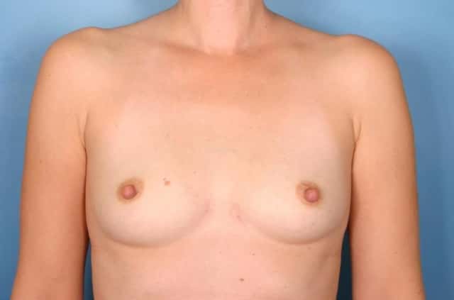 Breast Augmentation Before & After Case 76 before