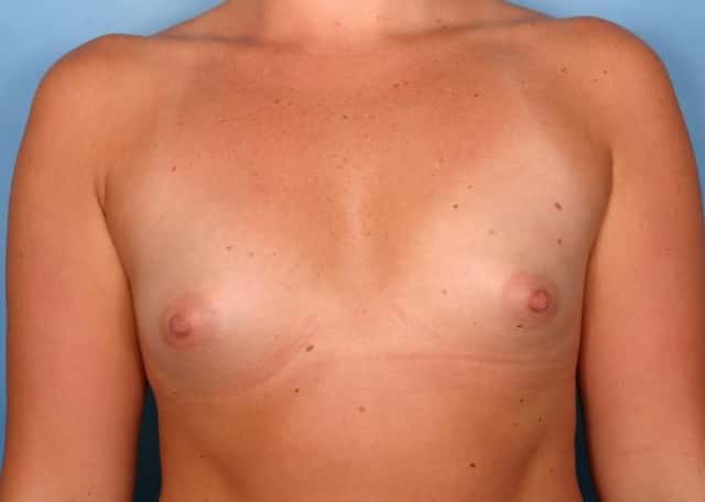 Breast Augmentation Before & After Case 88 before