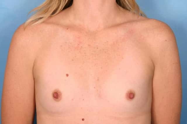 Breast Augmentation Before & After Case 96 before