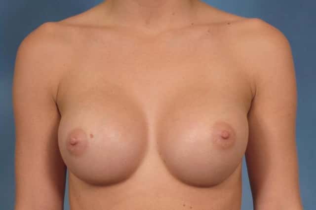 Breast Augmentation Before & After Case 98 after