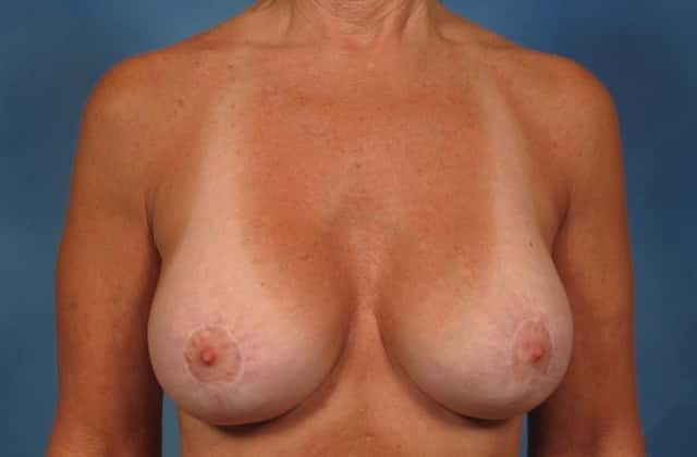 Breast Augmentation with Lift Before & After Case 252 after