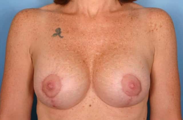 Breast Augmentation with Lift Before & After Case 55 after