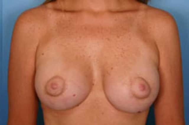 Breast Augmentation with Lift Before & After Case 6 after