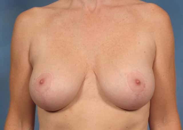 Breast Implant Exchange/Revision Before & After Case 131 after