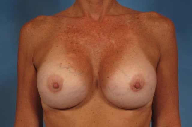 Breast Implant Exchange/Revision Before & After Case 168 after