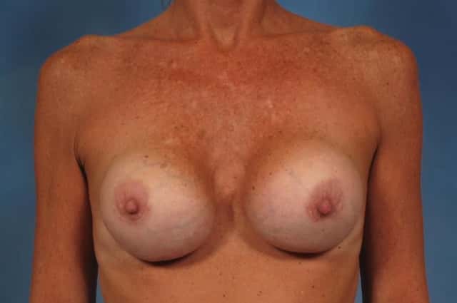 Breast Implant Exchange/Revision Before & After Case 168 before