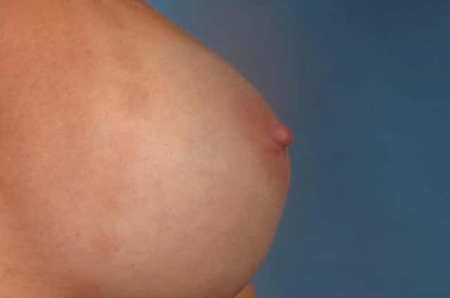 Breast Implant Exchange/Revision Before & After Case 308 after