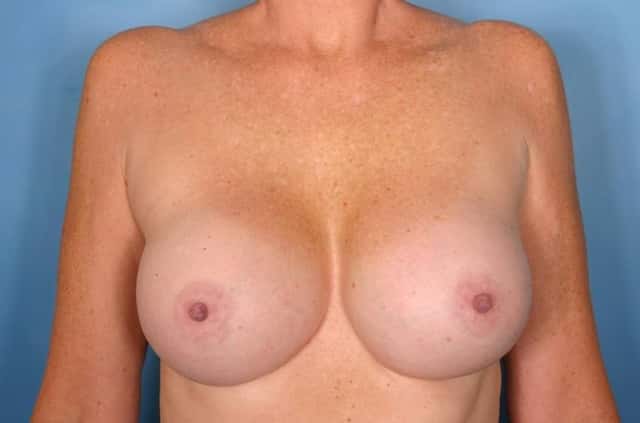 Breast Implant Exchange/Revision Before & After Case 32 after