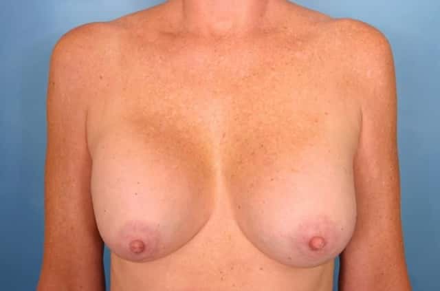 Breast Implant Exchange/Revision Before & After Case 32 before