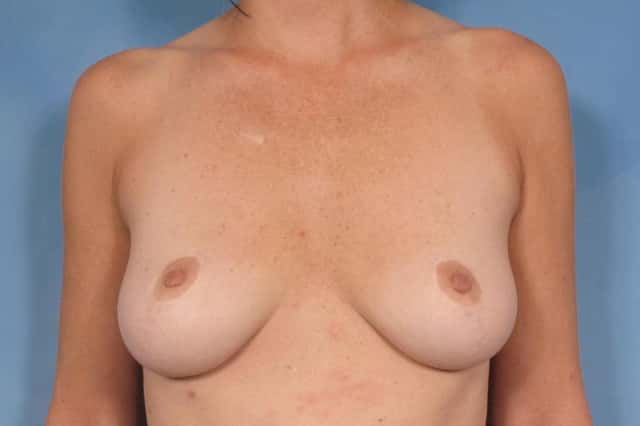 Breast Implant Removal for Patient Unhappy with the large size of the saline implants after