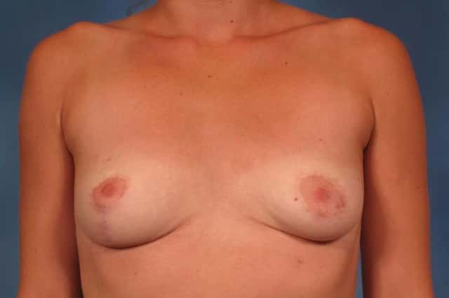 Breast Implant Removal and Lift for Patient who did not like her scars and size of her breasts after