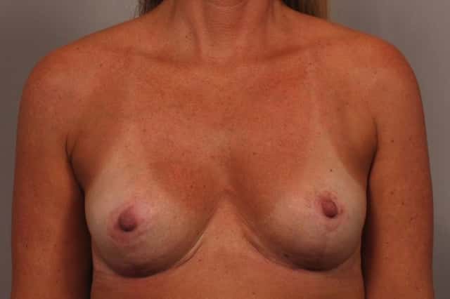 Breast Implant Removal and Lift for Patient who had pain and wanted to be smaller and perkier after
