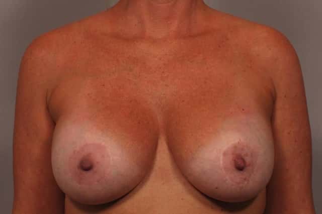 Breast Implant Removal and Lift for Patient who had pain and wanted to be smaller and perkier before