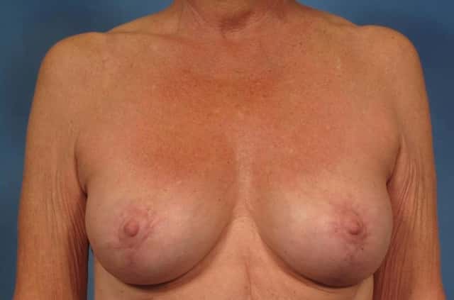 Breast Lift Before & After Case 169 after