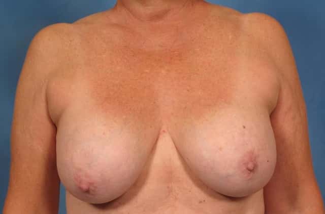 Breast Lift Before & After Case 169 before
