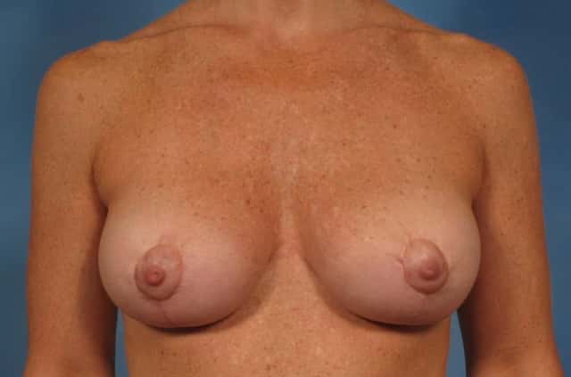 Breast Lift Before & After Case 199 after