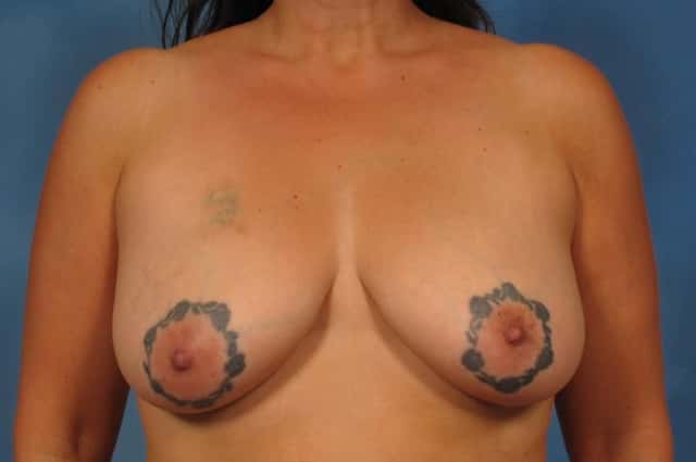 Breast Lift Before & After Case 239 before