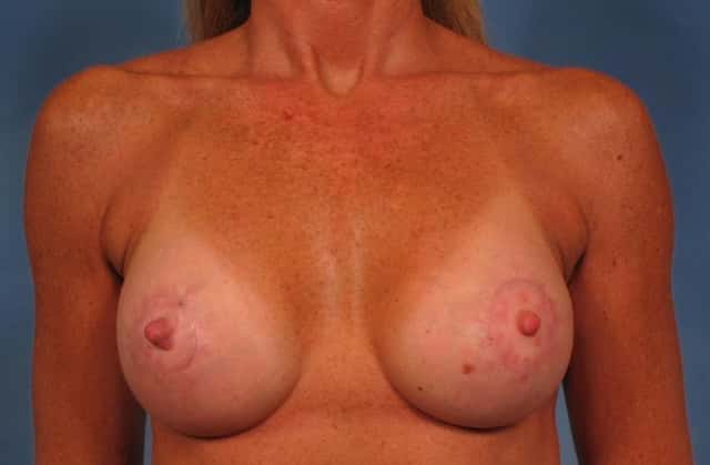 Breast Lift Before & After Case 272 after