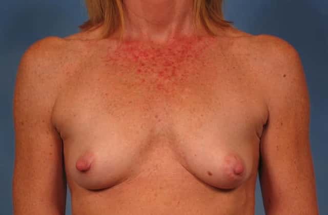 Breast Lift Before & After Case 272 before