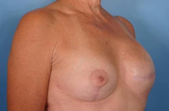 Breast Lift Before & After Case 34 after