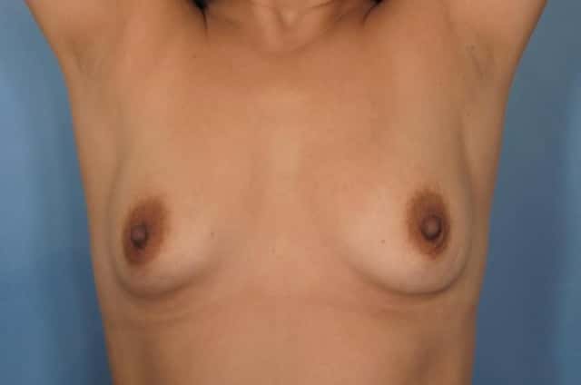 Breast Lift Before & After Case 93 before