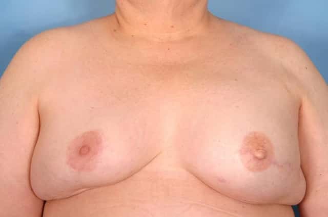 Breast Reconstruction Before & After Case 53 after