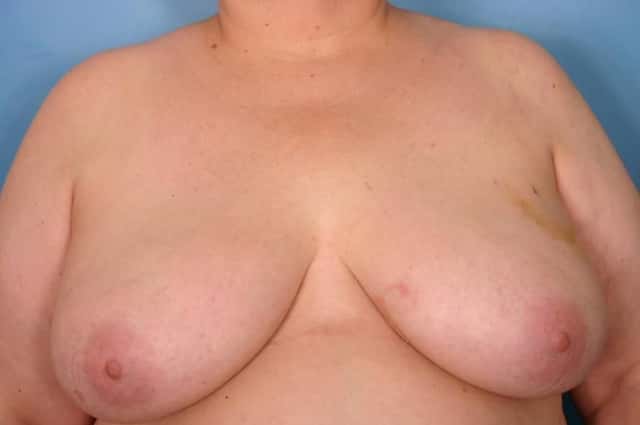 Breast Reconstruction Before & After Case 53 before
