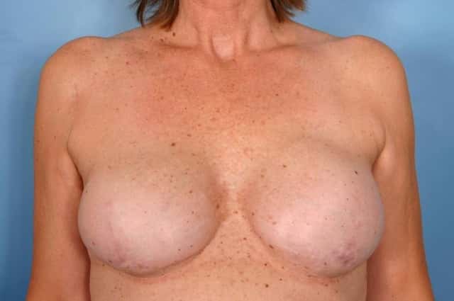 Breast Reconstruction Before & After Case 63 after